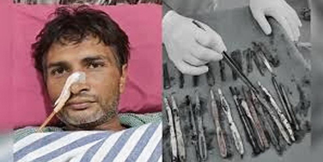 اتر پردیش :40 سالہ مریض کے معدے سے اسٹیل کے 29چمچ ،19برش اور 2 قلم برآمد ،ڈاکٹر ز بھی ہکا بکا ، آخر یہ بیماری ہے کیا ؟
