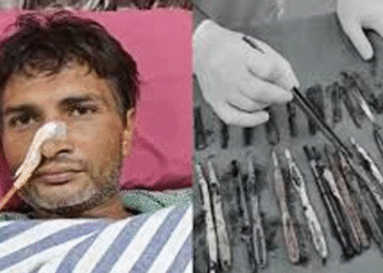 اتر پردیش :40 سالہ مریض کے معدے سے اسٹیل کے 29چمچ ،19برش اور 2 قلم برآمد ،ڈاکٹر ز بھی ہکا بکا ، آخر یہ بیماری ہے کیا ؟