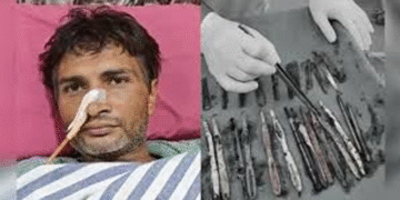 اتر پردیش :40 سالہ مریض کے معدے سے اسٹیل کے 29چمچ ،19برش اور 2 قلم برآمد ،ڈاکٹر ز بھی ہکا بکا ، آخر یہ بیماری ہے کیا ؟